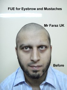 FUE Eyebrow and Eyelash Hair Transplant in Pakistan, by Dr M. Jawad Ch