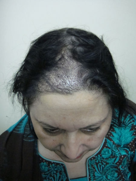 Woman FUE Hair Transplant performed at GHT By Dr M. Jawad Ch.  