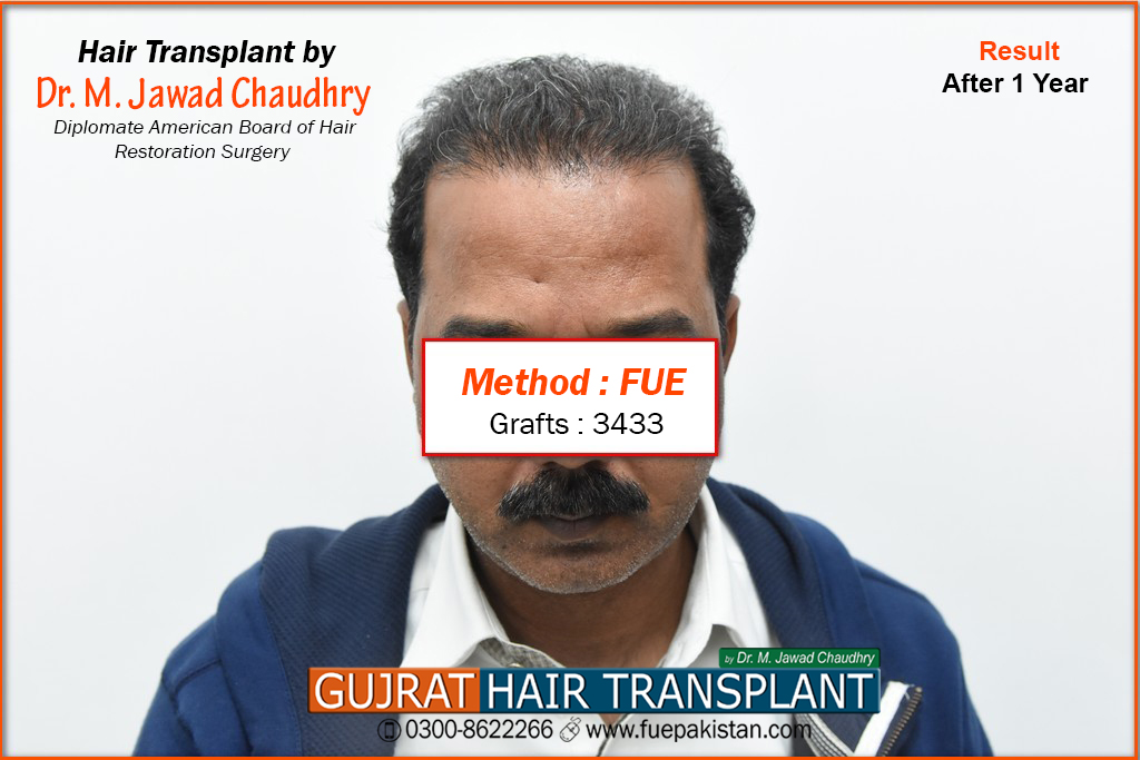 Beard & Head FUE Hair Transplant at GHT Pakistan - Gujrat Hair Transplant &  Laser Cosmetic Surgery Center